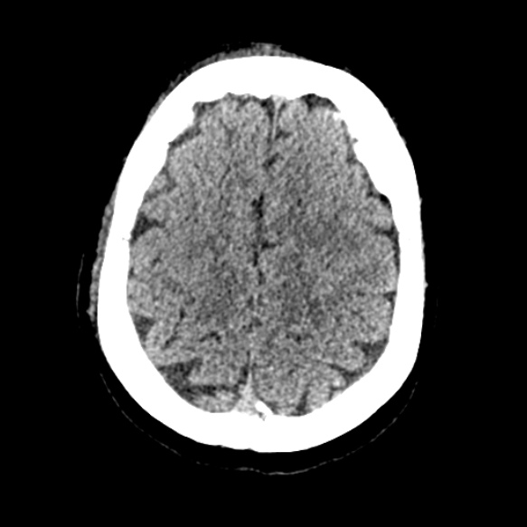 Acute middle cerebral artery territory infarct (Radiopaedia 52380-58283 Axial non-contrast 84).jpg