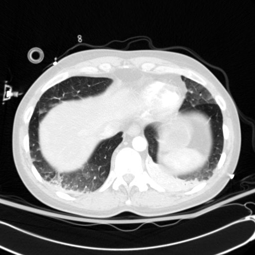 Acute myocardial infarction in CT (Radiopaedia 39947-42415 Axial lung window 111).jpg