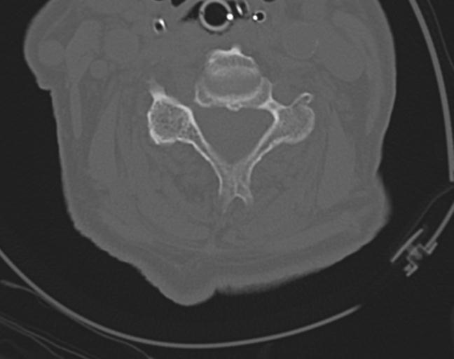 Acute on chronic subdural hematoma and thoracic vertebral injury in a multitrauma patient (Radiopaedia 31698-32619 Axial bone window 33).jpg