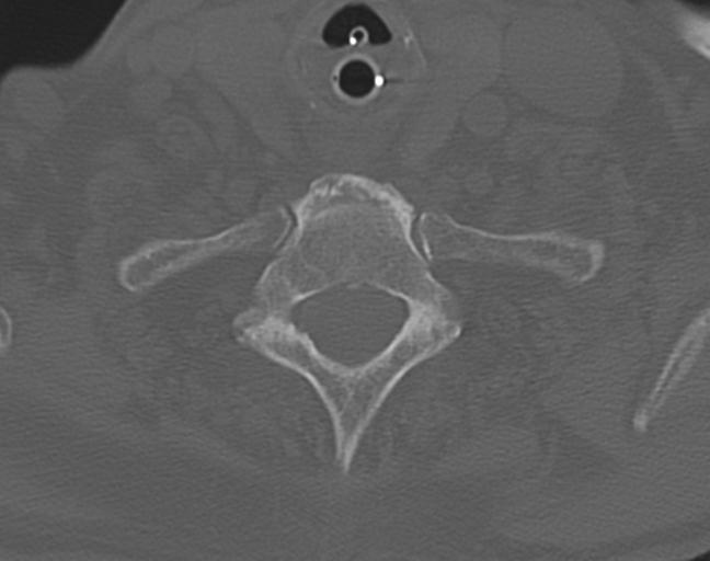Acute on chronic subdural hematoma and thoracic vertebral injury in a multitrauma patient (Radiopaedia 31698-32619 Axial bone window 51).jpg