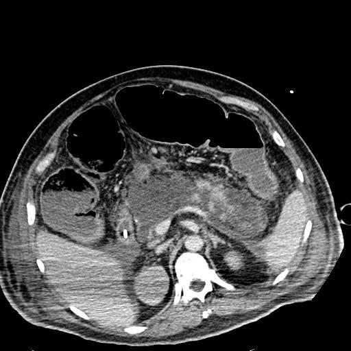 Acute pancreatic necrosis (Radiopaedia 13560-18501 Axial C+ portal venous phase 45).jpg