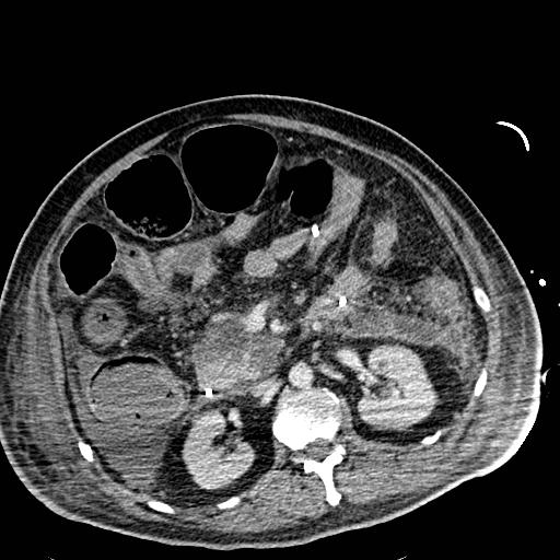 File:Acute pancreatic necrosis (Radiopaedia 13560-18501 Axial C+ portal venous phase 59).jpg