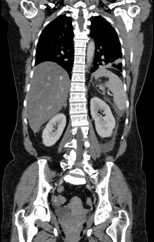 Acute pancreatitis (Radiopaedia 80007-93285 Coronal C+ portal venous phase 109).jpg