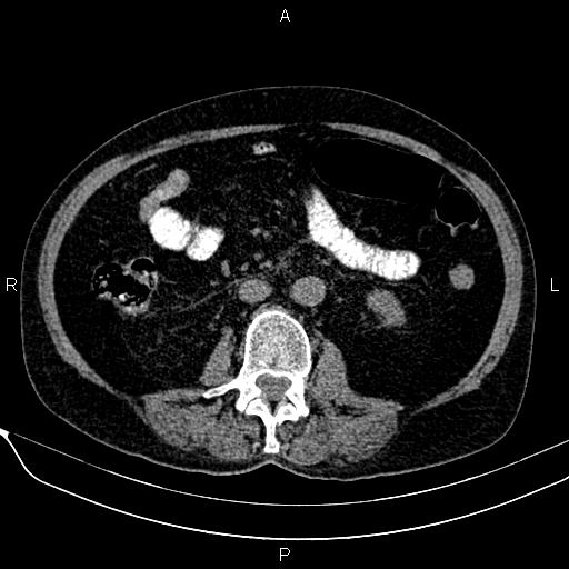 Acute pancreatitis (Radiopaedia 85146-100701 Axial non-contrast 66).jpg