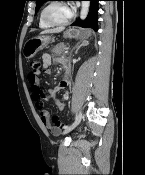 Acute pancreatitis - Balthazar E (Radiopaedia 23080-23110 Sagittal C+ portal venous phase 62).jpg