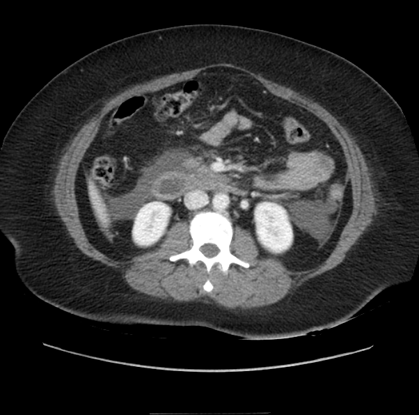 Acute pancreatitis - Balthazar E (Radiopaedia 29016-29377 Axial C+ portal venous phase 33).png