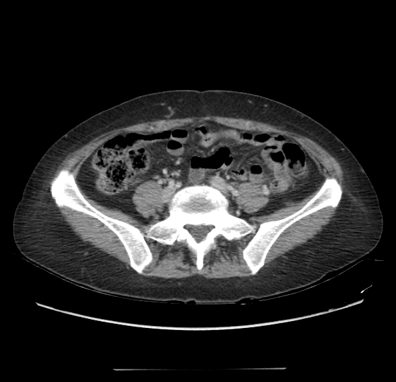 File:Acute pancreatitis - Balthazar E - post ERCP (Radiopaedia 27562-27772 Axial C+ portal venous phase 52).png