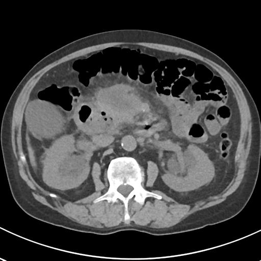 File:Acute pancreatitis and walled-off necrosis (Radiopaedia 29888-30404 Axial non-contrast 33).jpg