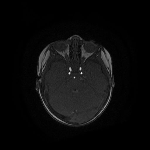 File:Acute phase of hemiconvulsion-hemiplegia epilepsy syndrome (Radiopaedia 29309-29745 Axial TOF angiography 103).jpg