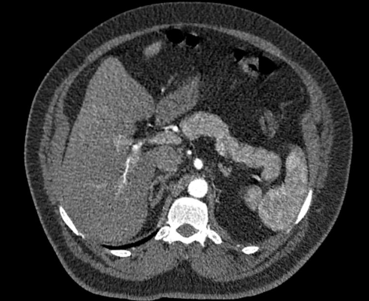 Acute pulmonary embolism with pulmonary infarcts (Radiopaedia 77688-89908 Axial C+ CTPA 78).jpg