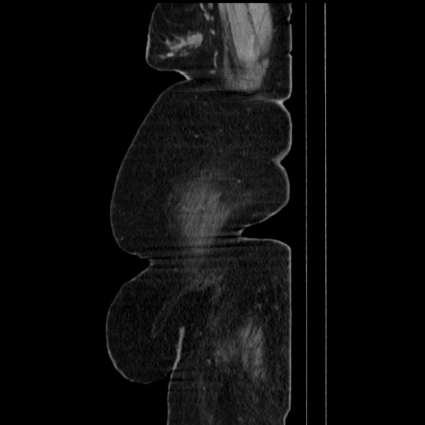 Acute pyelonephritis (Radiopaedia 25657-25837 Sagittal renal parenchymal phase 11).jpg