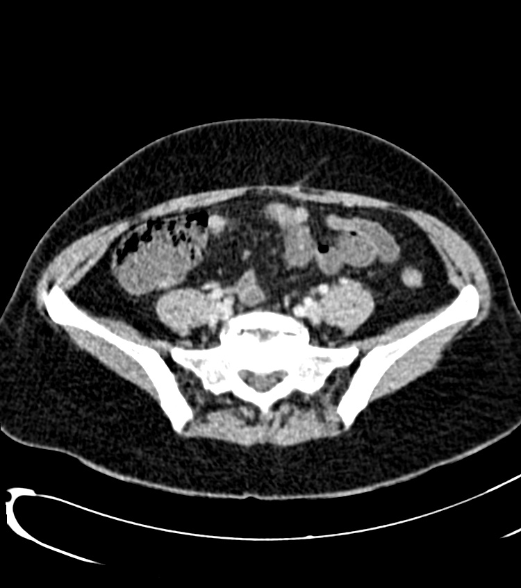 Acute pyelonephritis (Radiopaedia 40264-42816 Axial C+ portal venous phase 50).jpg