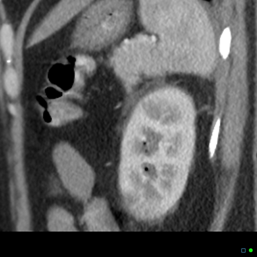 File:Acute pyelonephritis and emphysematous pyonephrosis (Radiopaedia 27893-28128 renal cortical phase 4).jpg