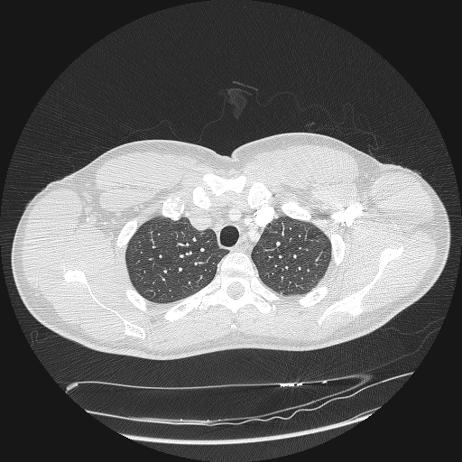 File:Acute segmental pulmonary emboli and pulmonary infarction (Radiopaedia 62264-70444 Axial lung window 30).jpg