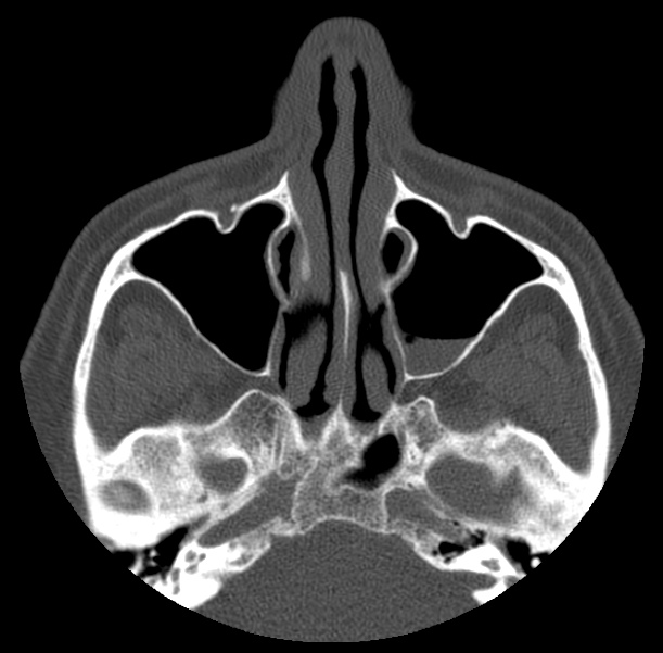 Acute sinusitis (Radiopaedia 23161-23215 Axial bone window 26).jpg