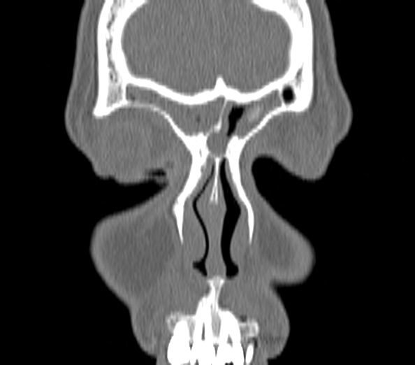 Acute sinusitis (Radiopaedia 40564-43158 Coronal bone window 3).jpg