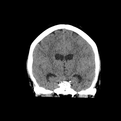 Acute subarachnoid hemorrhage and accessory anterior cerebral artery (Radiopaedia 69231-79008 Coronal non-contrast 38).jpg