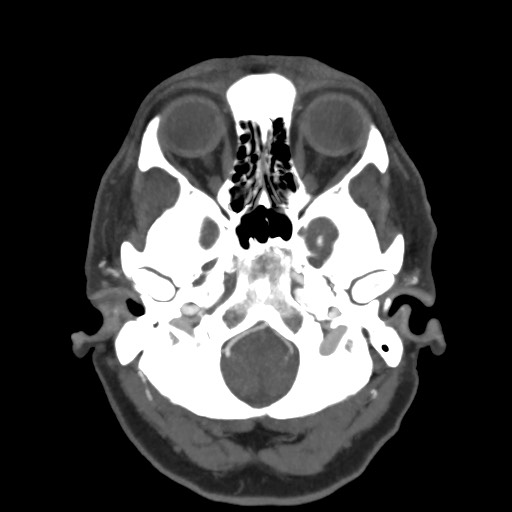 Acute subarachnoid hemorrhage and accessory anterior cerebral artery (Radiopaedia 69231-79009 D 13).jpg