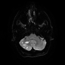 Acute superior cerebellar artery territory infarct (Radiopaedia 84104-99358 Axial DWI 26).jpg