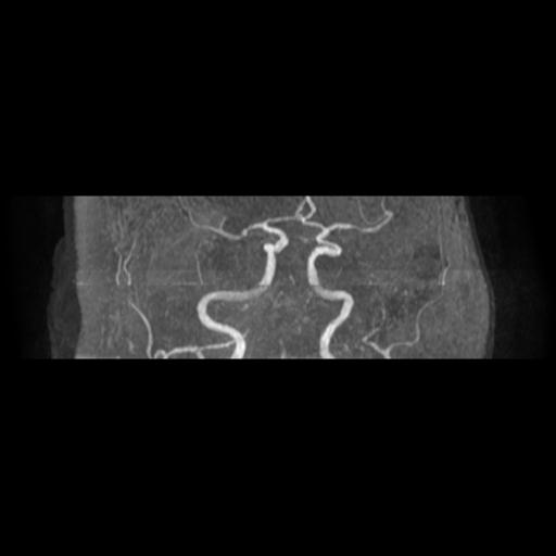 File:Acute vertebrobasilar ischemic infarction (Radiopaedia 25220-25474 Axial MRA 14).jpg