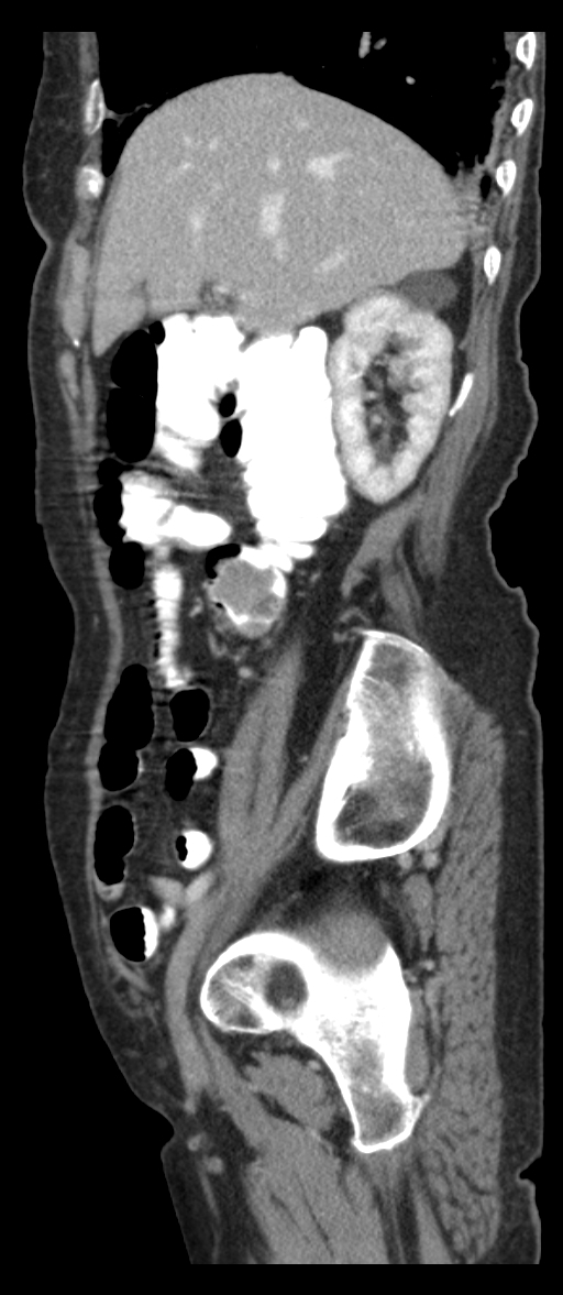 Adenocarcinoma of cecum (Radiopaedia 59222-66549 Sagittal C+ portal venous phase 70).jpg