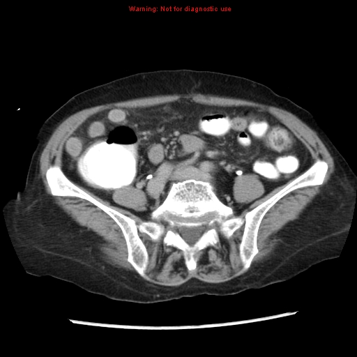 File:Adenocarcinoma of the colon (Radiopaedia 8191-9039 Axial renal excretory phase 36).jpg