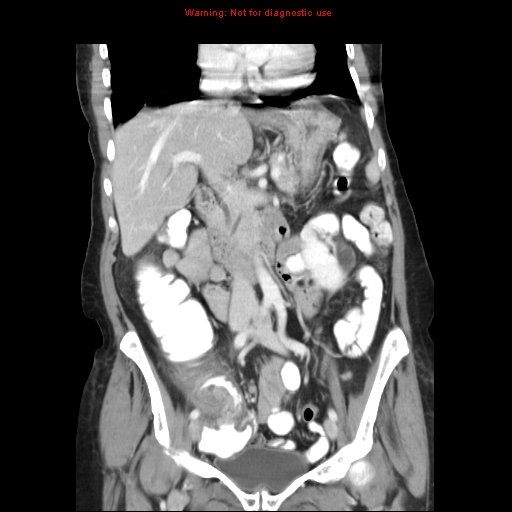 File:Adenocarcinoma of the colon (Radiopaedia 8191-9039 Coronal liver window 21).jpg