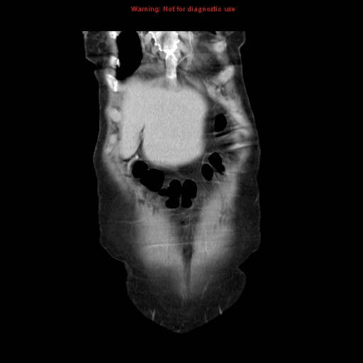 File:Adenocarcinoma of the colon (Radiopaedia 8191-9039 Coronal liver window 7).jpg