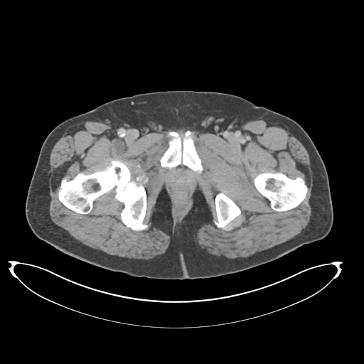 File:Adenocarcioma of rectum- T1 lesion (Radiopaedia 36921-38547 Axial C+ portal venous phase 91).png