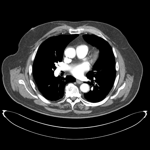 Adenocarcioma of rectum- T1 lesion (Radiopaedia 36921-38547 Coronal C+ arterial phase 1).png