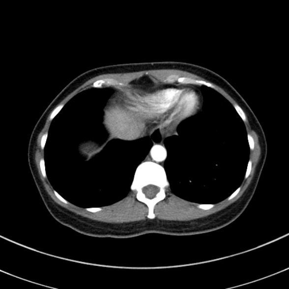 File:Adenocystic carcinoma of the trachea (Radiopaedia 47677-52525 Axial C+ arterial phase 70).jpg