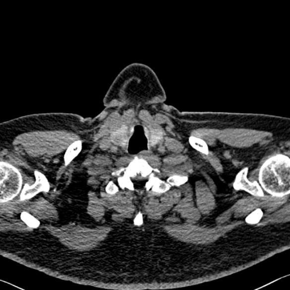 Adenoid cystic carcinoma of the trachea (Radiopaedia 49042-54137 Axial non-contrast 45).jpg