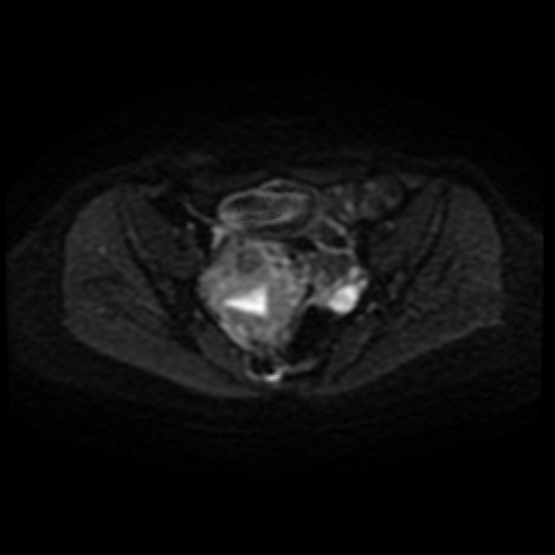 File:Adenoma malignum of cervix (Radiopaedia 66441-75705 Axial DWI 33).jpg