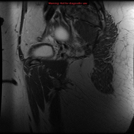 File:Adenomyosis (Radiopaedia 8972-9748 Sagittal T2 22).jpg