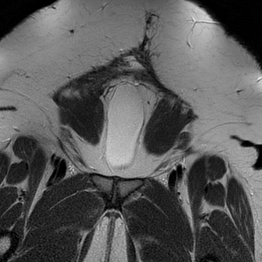 File:Adenomyosis within a didelphys uterus (Radiopaedia 70175-80215 Coronal T2 2).jpg
