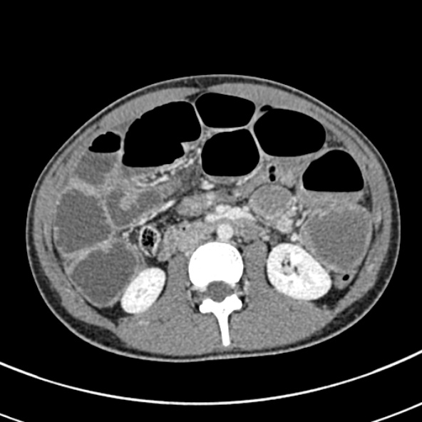 File:Adhesional small bowel obstruction (Radiopaedia 52107-57980 Axial C+ portal venous phase 53).jpg