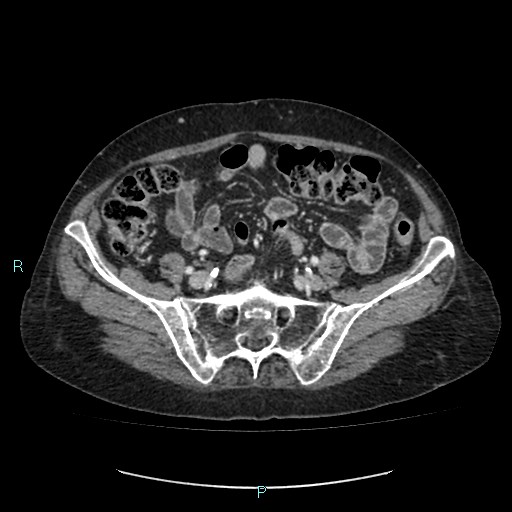 File:Adrenal collision tumor (ACT) (Radiopaedia 48462-53379 Axial C+ portal venous phase 45).jpg