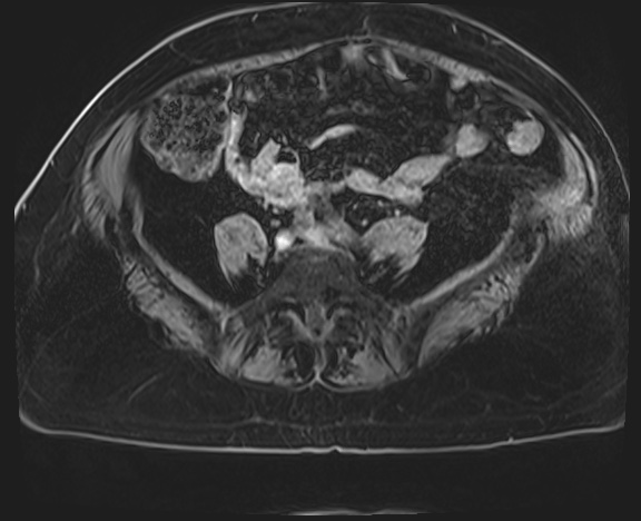 Adrenal cortical carcinoma (Radiopaedia 64017-72770 Axial T1 C+ fat sat 62).jpg