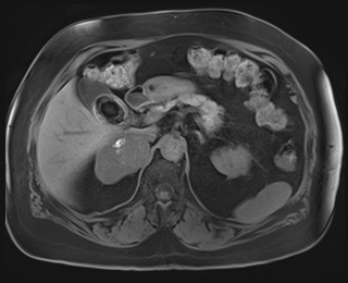 Adrenal cortical carcinoma (Radiopaedia 64017-72770 Axial T1 fat sat 28).jpg