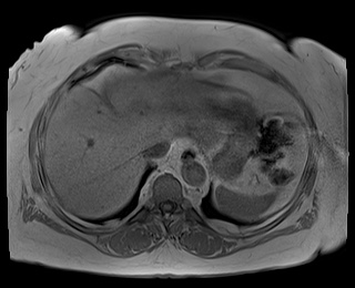 File:Adrenal cortical carcinoma (Radiopaedia 64017-72770 Axial T1 in-phase 5).jpg