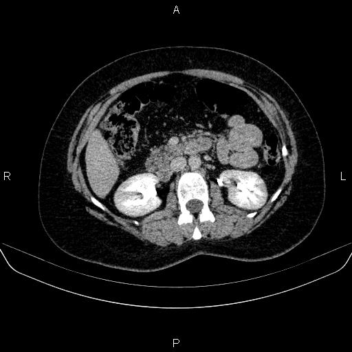 Adrenal cortical carcinoma (Radiopaedia 84882-100379 Axial C+ delayed 37).jpg