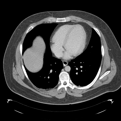 File:Adrenal cyst (Radiopaedia 45625-49776 Axial C+ portal venous phase 7).png
