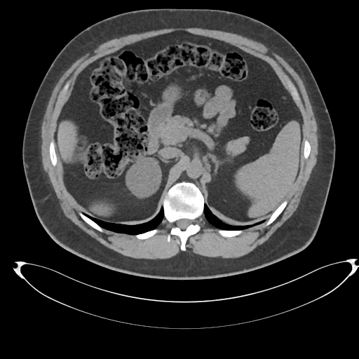 Adrenal cyst (Radiopaedia 45625-49778 Axial non-contrast 34).png