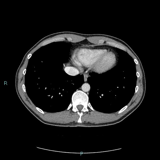 Adrenal cystic lymphangioma (Radiopaedia 83161-97534 Axial C+ portal venous phase 9).jpg