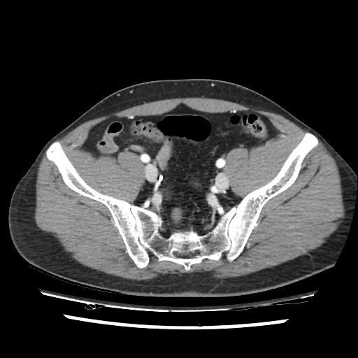 Adrenal gland trauma (Radiopaedia 81351-95078 Axial Dual bolus trauma C+ 104).jpg