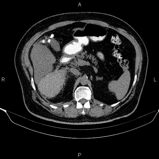 Adrenal hemorrhage (Radiopaedia 62622-70916 Axial non-contrast 64).jpg