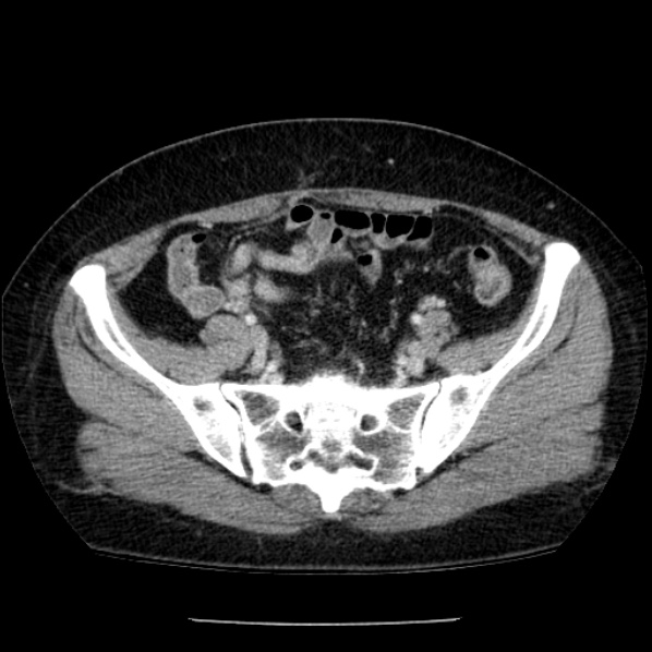 Adrenal myelolipoma (Radiopaedia 43401-46759 Axial C+ portal venous phase 69).jpg