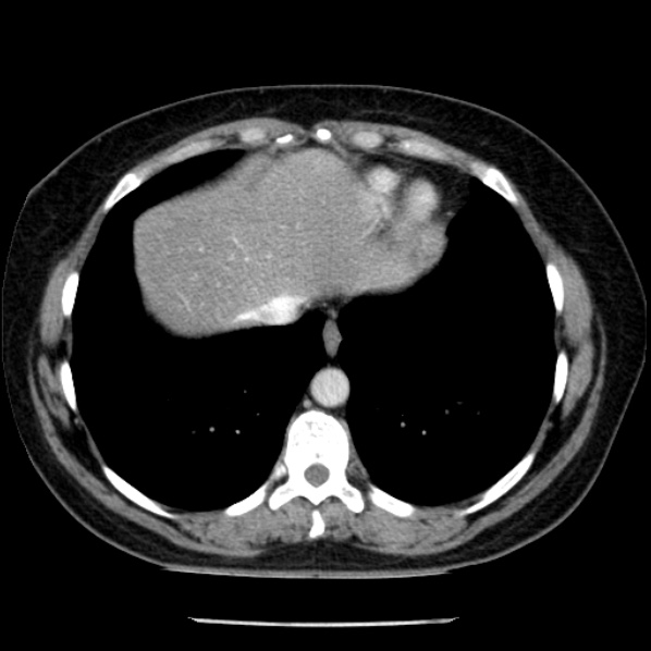 Adrenal myelolipoma (Radiopaedia 43401-46759 Axial C+ portal venous phase 7).jpg
