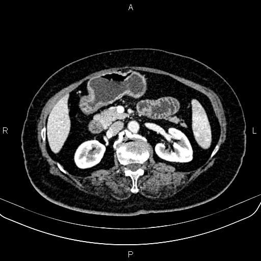 Adrenal myelolipoma (Radiopaedia 82742-96986 Axial renal cortical phase 71).jpg