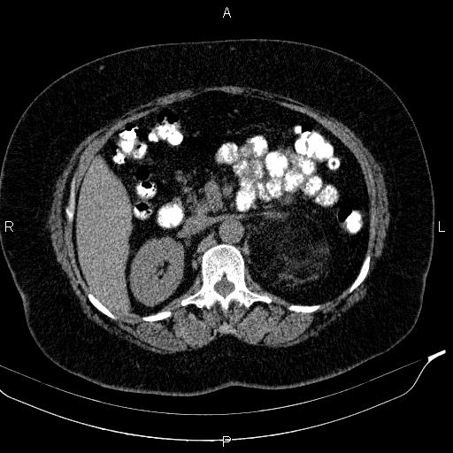 Adrenal myelolipoma (Radiopaedia 84319-99617 Axial With oral contrast 83).jpg